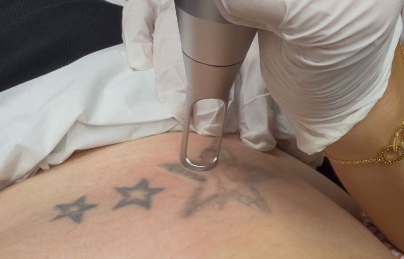 detatouage epilia laser ps400
