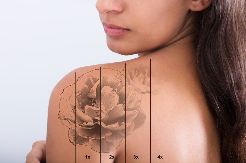 detatouage epilia pourquoi choisir epilia